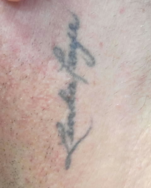 Paul Cohagen Left Side of Neck