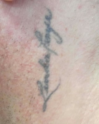 Paul Cohagen Left Side of Neck